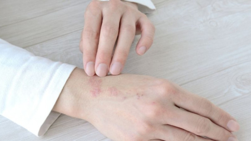 Soğuk yanığına ne iyi gelir ve nasıl düzelir?