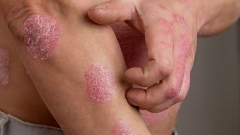 Sedef hastalığı nedir? Belirtileri ve tedavileri