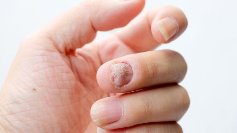 Vücut mantarı nedir ve neden oluşur, ne iyi gelir, evde tedavisi nasıl?