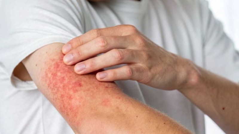 Zyrtec şurup nedir nedir, ne işe yarar, kimler kullanır ve fiyatı ne kadar?