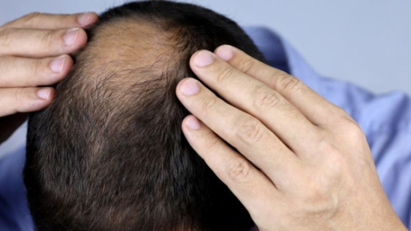 Saç dökülmesine karşı ne iyi gelir, evde tedavi, nasıl  çıkar ve dökmeyen şampuan hangisi?
