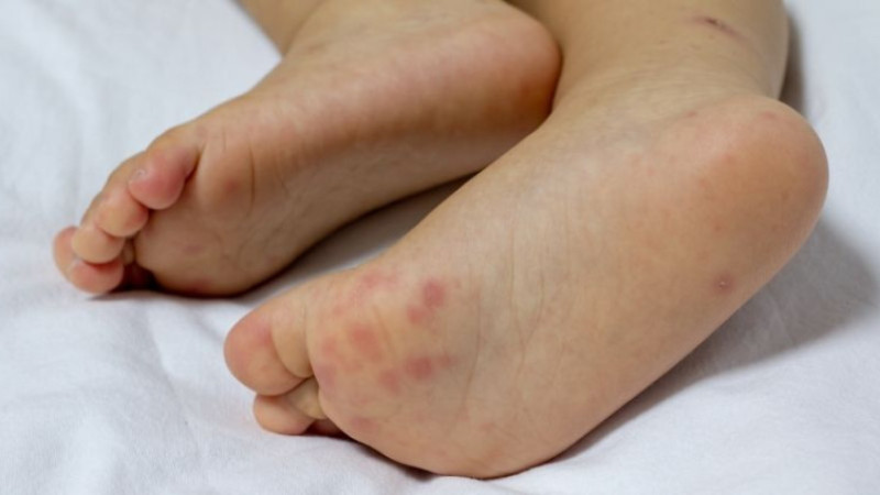 El ayak hastalığı nedir? Belirtileri, tedavileri ve nedenleri